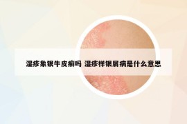 湿疹象银牛皮癣吗 湿疹样银屑病是什么意思