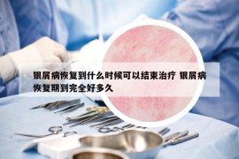 银屑病恢复到什么时候可以结束治疗 银屑病恢复期到完全好多久