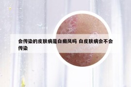 会传染的皮肤病是白癜风吗 白皮肤病会不会传染