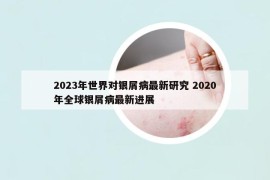 2023年世界对银屑病最新研究 2020年全球银屑病最新进展