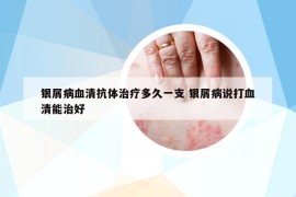 银屑病血清抗体治疗多久一支 银屑病说打血清能治好