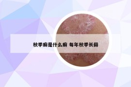 秋季癣是什么癣 每年秋季长藓