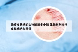 治疗皮肤病的生物制剂多少钱 生物制剂治疗皮肤病纳入医保