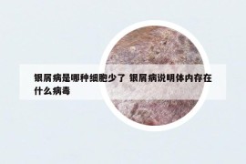 银屑病是哪种细胞少了 银屑病说明体内存在什么病毒