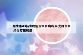 维生素d3衍生物能治银屑病吗 补充维生素d3治疗银屑病