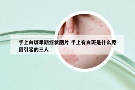 手上白斑早期症状图片 手上有白斑是什么原因引起的三人