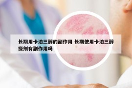 长期用卡泊三醇的副作用 长期使用卡泊三醇搽剂有副作用吗