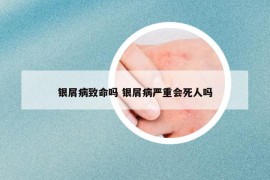 银屑病致命吗 银屑病严重会死人吗