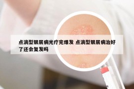 点滴型银屑病光疗完爆发 点滴型银屑病治好了还会复发吗