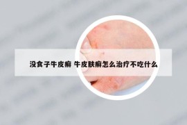 没食子牛皮癣 牛皮肤癣怎么治疗不吃什么