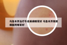 乌鲁木齐治疗牛皮癣病哪家好 乌鲁木齐银屑病医院哪家好