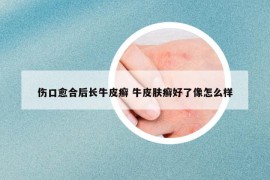 伤口愈合后长牛皮癣 牛皮肤癣好了像怎么样