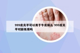 999皮炎平可以用于牛皮癣么 999皮炎平对藓有用吗