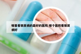 哪里看银屑病的最好的医院 哪个医院看银屑病好