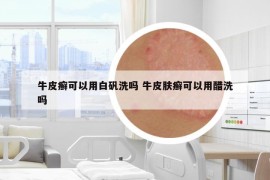 牛皮癣可以用白矾洗吗 牛皮肤癣可以用醋洗吗