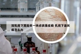 双乳房下窝处长一块点状像皮癣 乳房下面长癣怎么办