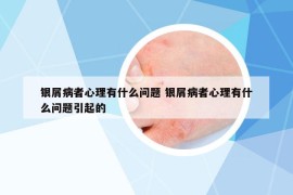 银屑病者心理有什么问题 银屑病者心理有什么问题引起的