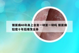 银屑病40年身上会青一块紫一块吗 银屑病轻度十年后爆发全身