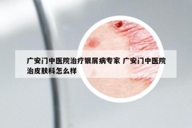 广安门中医院治疗银屑病专家 广安门中医院治皮肤科怎么样