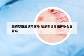 脓疱型银屑病可怀孕 脓疱型银屑病怀孕会复发吗