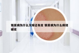 银屑病为什么又痒还有皮 银屑病为什么痒挠破皮