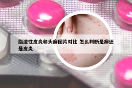 脂溢性皮炎和头癣图片对比 怎么判断是癣还是皮炎