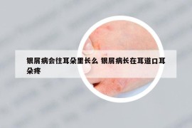 银屑病会往耳朵里长么 银屑病长在耳道口耳朵疼