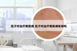 出汗对治疗银屑病 出汗对治疗银屑病有用吗