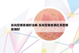 反向型银屑病好治嘛 反向型银屑病比其他银屑病好