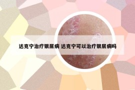 达克宁治疗银屑病 达克宁可以治疗银屑病吗