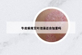 牛皮癣用艾叶泡澡还会加重吗