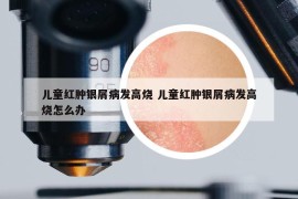 儿童红肿银屑病发高烧 儿童红肿银屑病发高烧怎么办