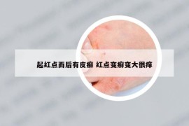 起红点而后有皮癣 红点变癣变大很痒