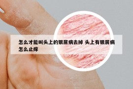 怎么才能叫头上的银屑病去掉 头上有银屑病怎么止痒