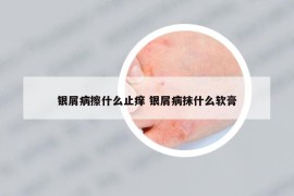 银屑病擦什么止痒 银屑病抹什么软膏