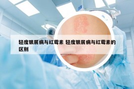 轻度银屑病与红霉素 轻度银屑病与红霉素的区别