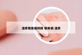 湿疹银屑病待排 银屑病 湿疹