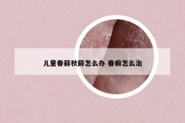 儿童春藓秋藓怎么办 春癣怎么治