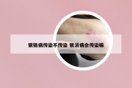 银销病传染不传染 银消病会传染嘛