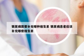 银屑病需要补充哪种维生素 银屑病患者应该补充哪些维生素