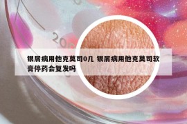 银屑病用他克莫司0几 银屑病用他克莫司软膏停药会复发吗