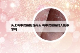 头上有牛皮癣能当兵么 有牛皮病癣的人能参军吗