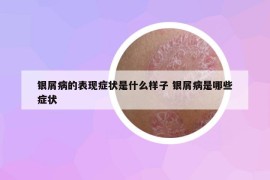 银屑病的表现症状是什么样子 银屑病是哪些症状