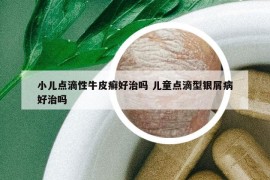 小儿点滴性牛皮癣好治吗 儿童点滴型银屑病好治吗