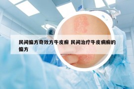 民间偏方奇效方牛皮癣 民间治疗牛皮病癣的偏方