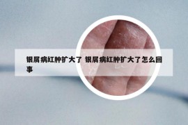 银屑病红肿扩大了 银屑病红肿扩大了怎么回事