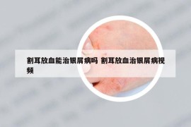 割耳放血能治银屑病吗 割耳放血治银屑病视频