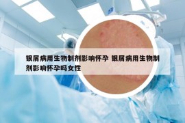 银屑病用生物制剂影响怀孕 银屑病用生物制剂影响怀孕吗女性