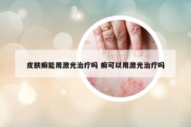 皮肤癣能用激光治疗吗 癣可以用激光治疗吗