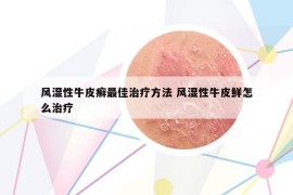 风湿性牛皮癣最佳治疗方法 风湿性牛皮鲜怎么治疗